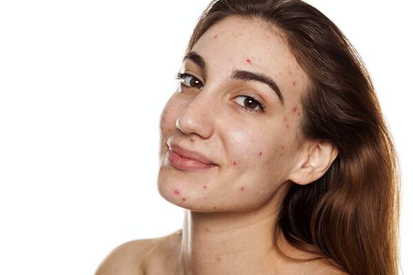Image for National Acne Positivity Day